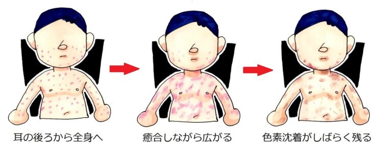 麻疹(はしか):空気感染なのですぐに広がります | ママはホームドクター